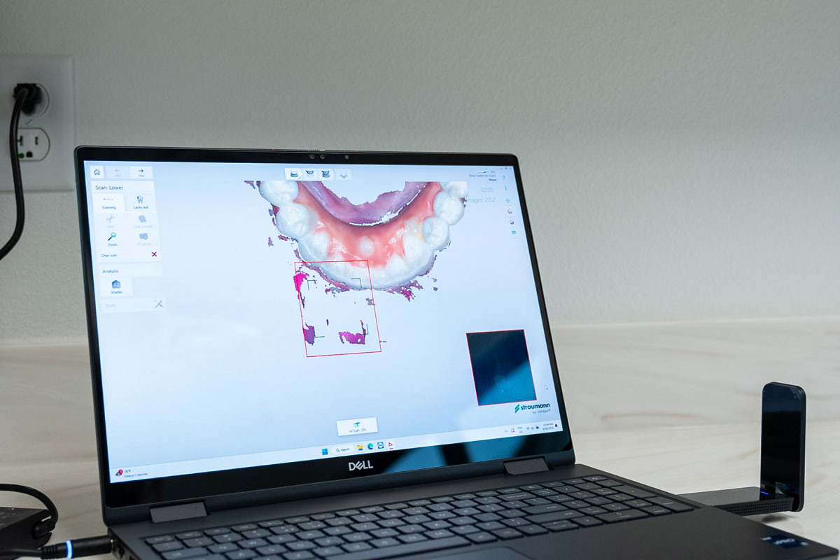 3d Modeled Newly Placed Teeth Made With Advanced Dental Scanners