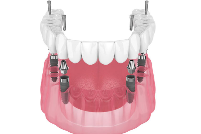 3D illustration of a full upper dental arch implant system, full set of upper teeth being attached. set against a white background