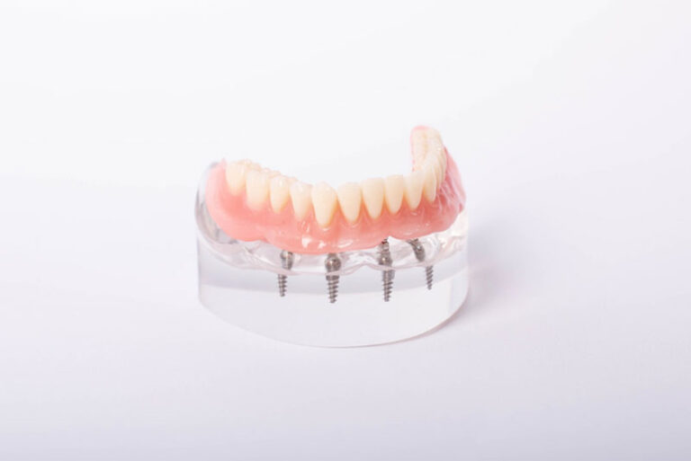 All-on-4 implant-supported denture model on a white background, showing screws and full lower arch fixed to a clear acrylic base.