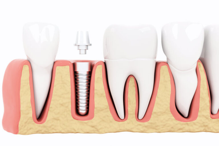 Cross-sectional 3D illustration of dental implant placed in jaw bone between natural teeth. Implant post embedded in the bone, ready for a dental crown