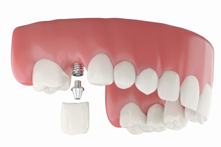 3D Illustration of Dental implant model replacement in the upper jaw. a metal implant post embedded in the jaw, all set against a white background.