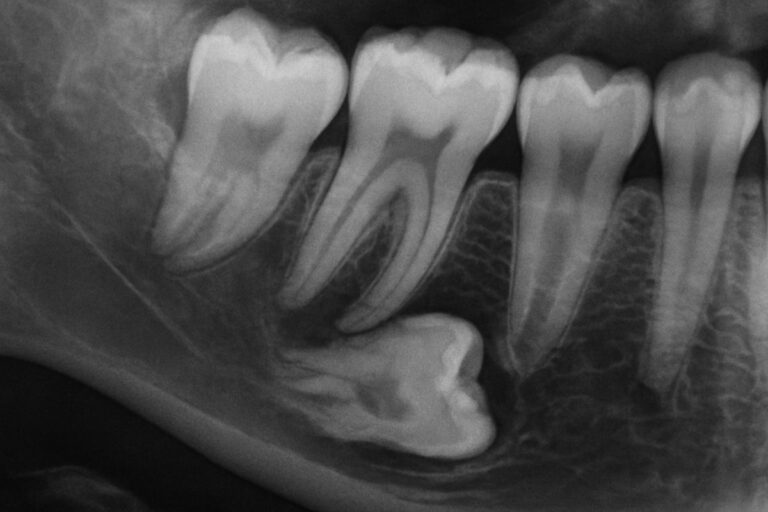 A close-up x-ray of bottom wisdom teeth impacted in the jaw, with one tooth pressing against the adjacent molar, causing potential damage. No text on image.