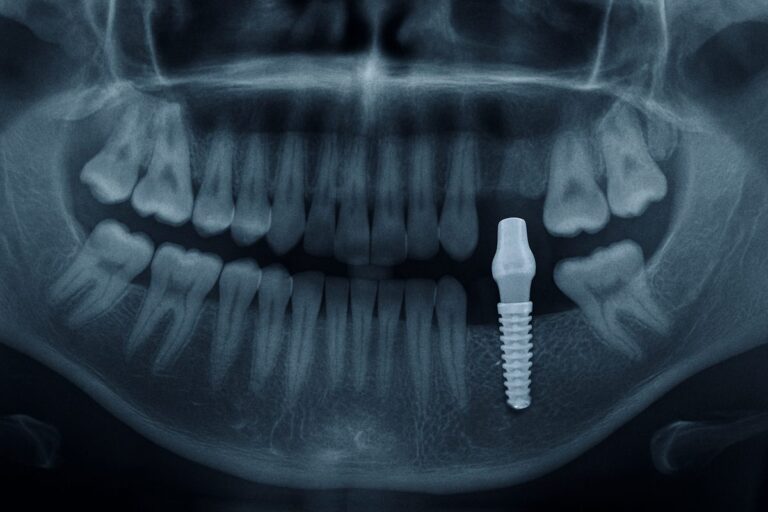 Image of a mouth x-ray showing a dental implant in the lower jaw, with an emphasis on the implant integrating with the jaw bone. No text on the image.