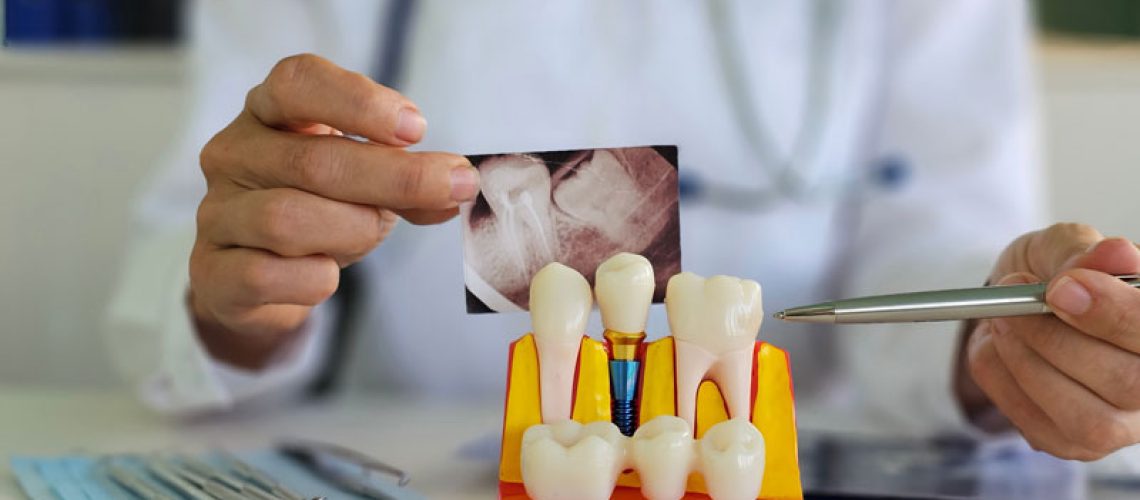 Dental professional examines tooth model and X-ray to assess patient condition and treatment options