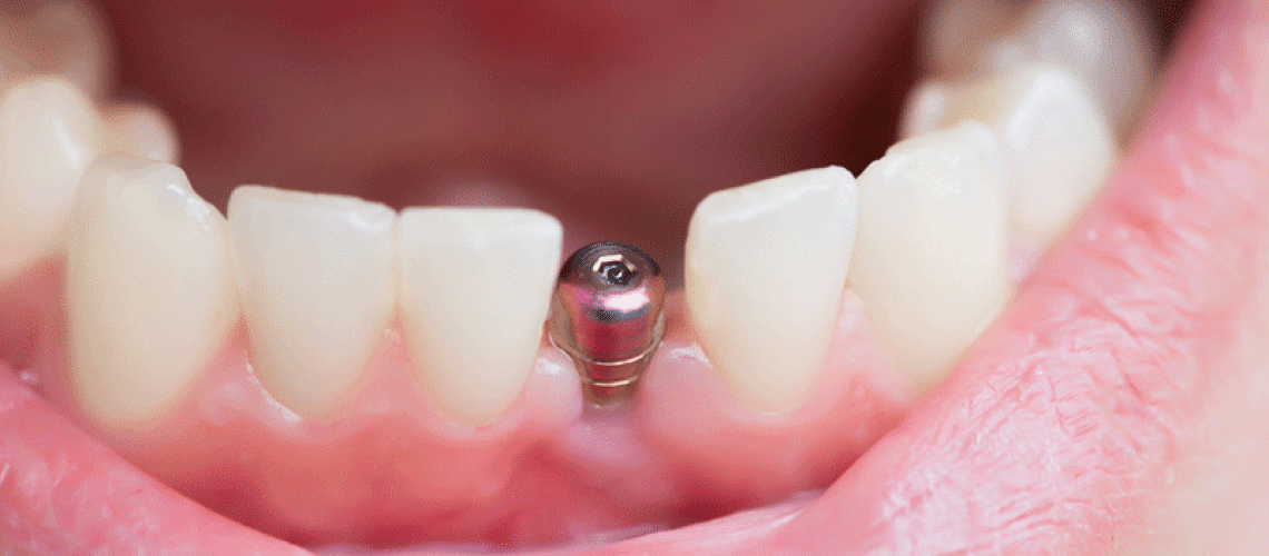 close up shot of a patient’s mouth with a single implant.