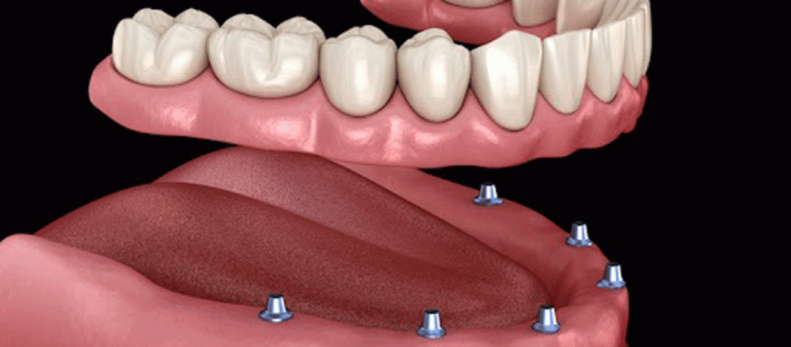 an image of dental implants.