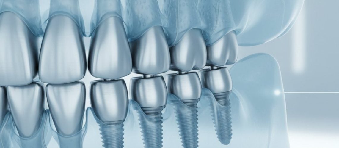 Digital 3D model of a semi-transparent jawbone with titanium dental implants. Cool blues, whites, and grays.