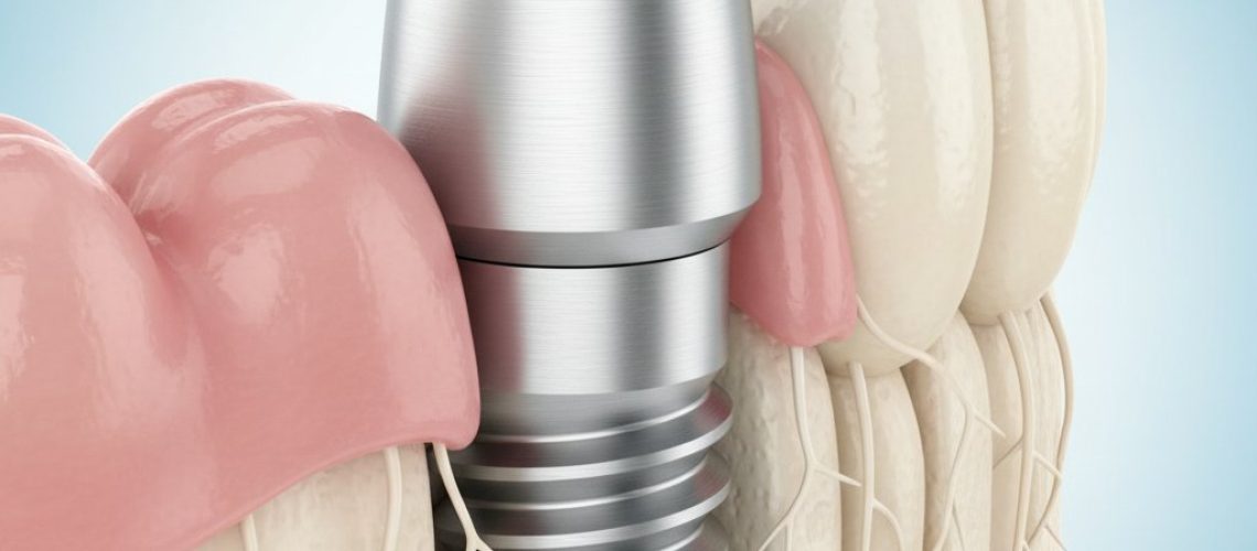 Close-up 3D render of a healthy jawbone with a titanium dental implant, integrated with gum tissue, against a soft blue gradient.