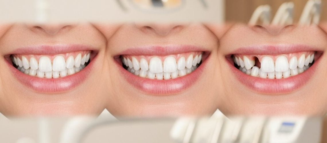 Smile transitioning from missing tooth to dental implant, resolving in a full, confident smile. Soft light, blurred dental office background.