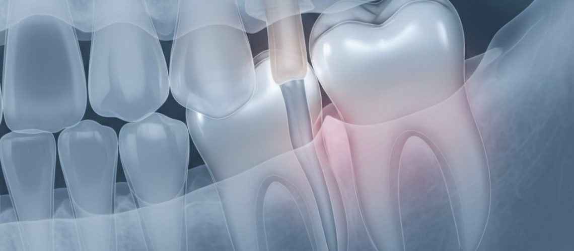 _1760378194 Stylized dental x-ray of lower jaw shows impacted wisdom teeth pressing against molar roots. Muted blues, greys, pink hints. Sharp focus.