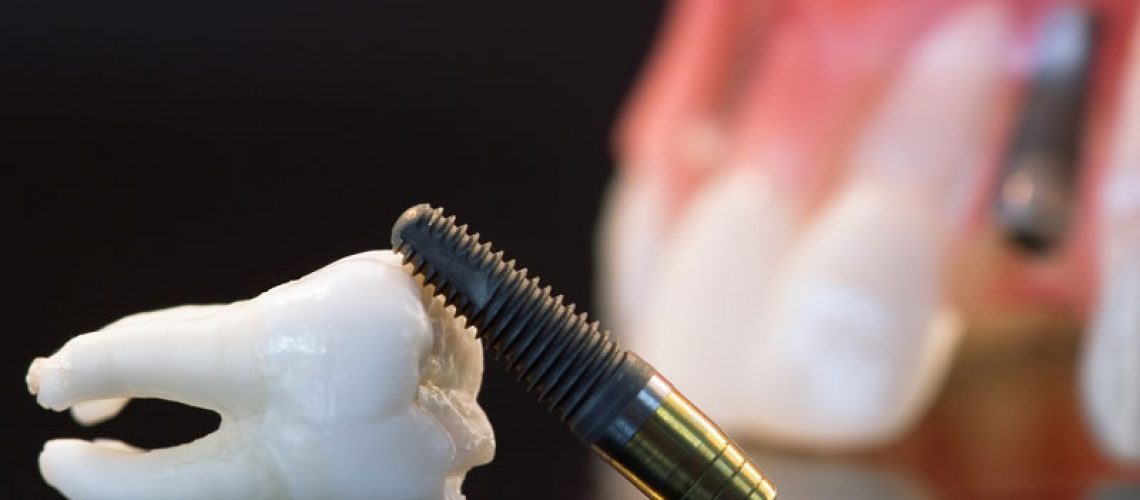 2024-05-implant-resting-on-tooth