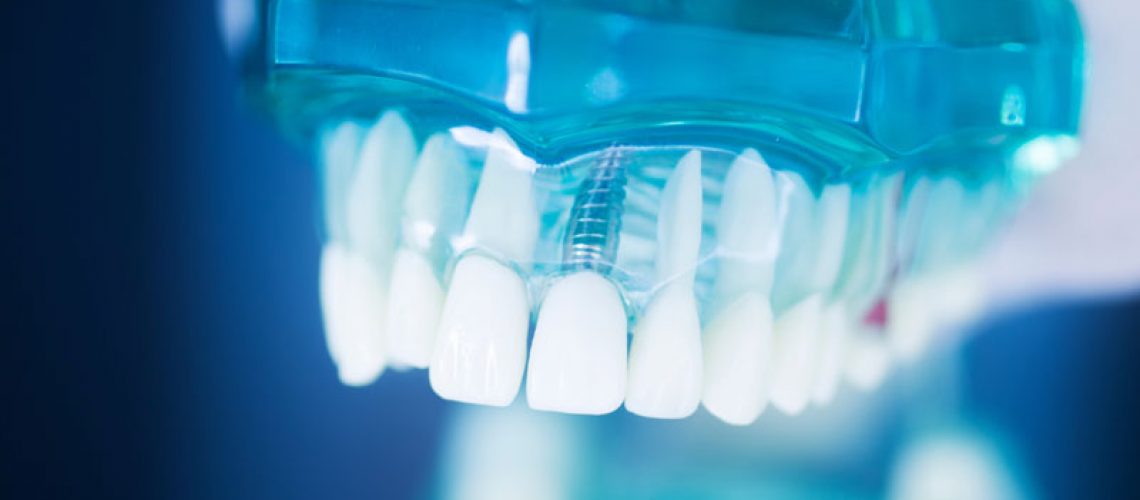 2024-08-Imp4-Dental-tooth-implant-titanium-prosthetic-dentists-model