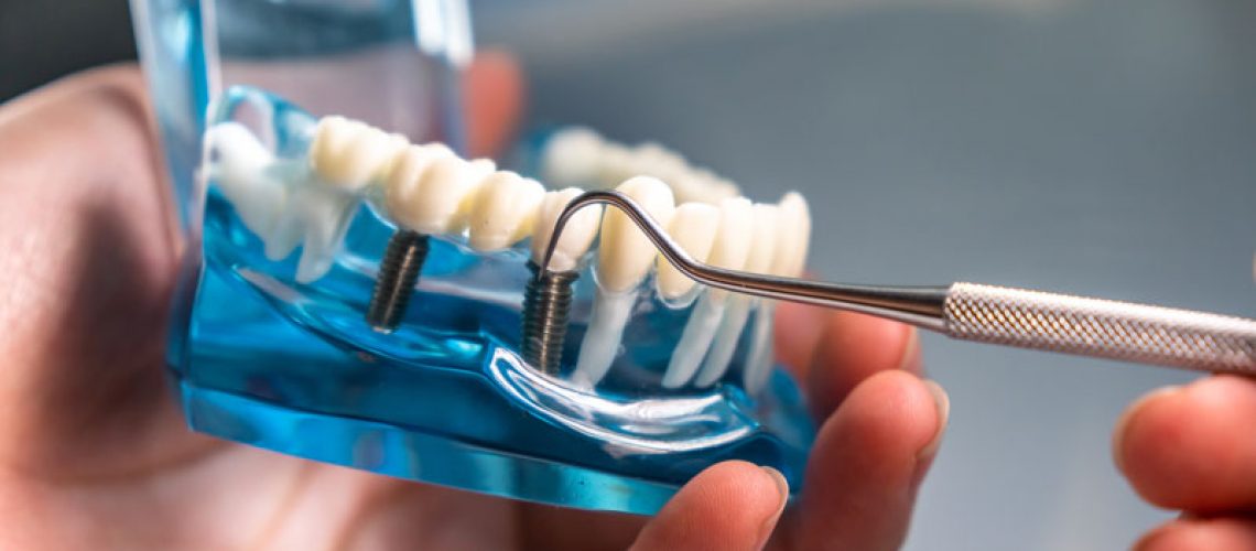 2024-4-Dental-Implants-1