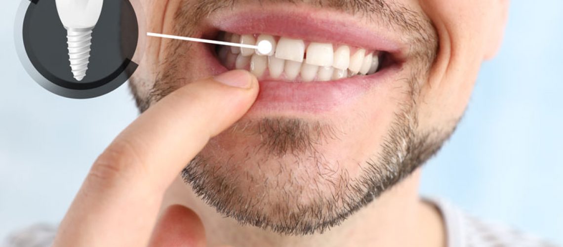 2024-4-Dental-Implants-2