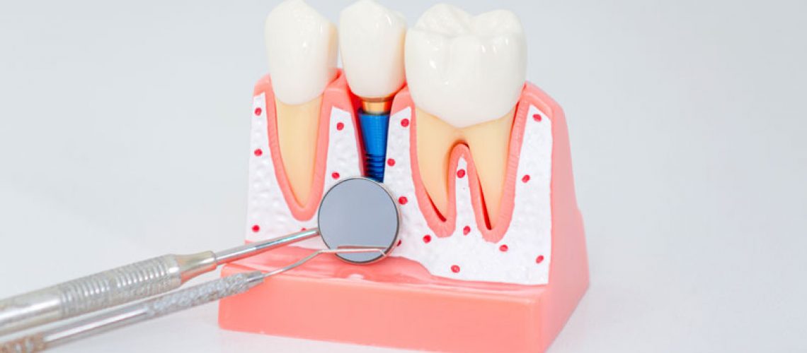 Dental implant, artificial tooth roots into jaw, root canal of dental treatment, gum disease, teeth model for dentist studying about dentistry