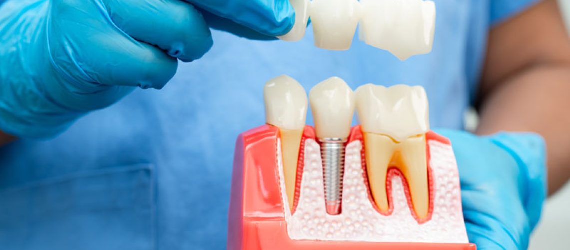 Dentist demonstrates dental implants and crown models in a clinical setting during consultation.