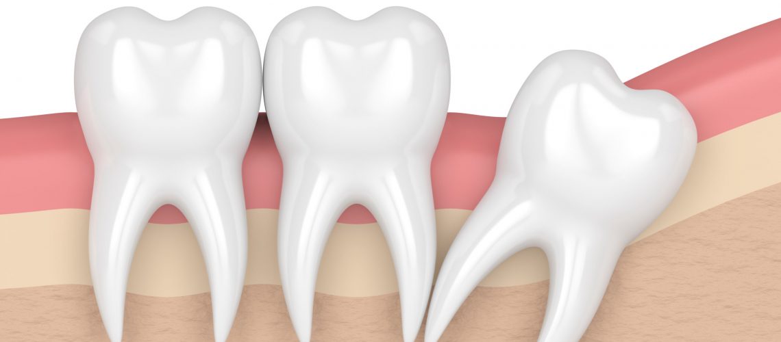 3d render of teeth with wisdom distal impaction.