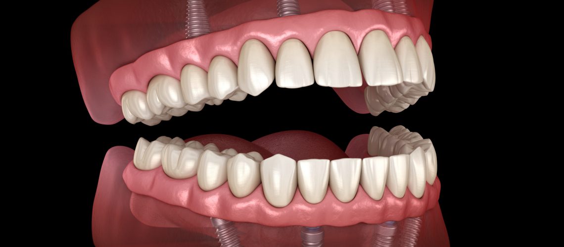image of an all on 4 dental implants 3D model.