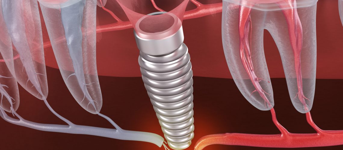 Result of unsuccessful dental implantation - nerve break. Medically accurate dental 3D illustration.