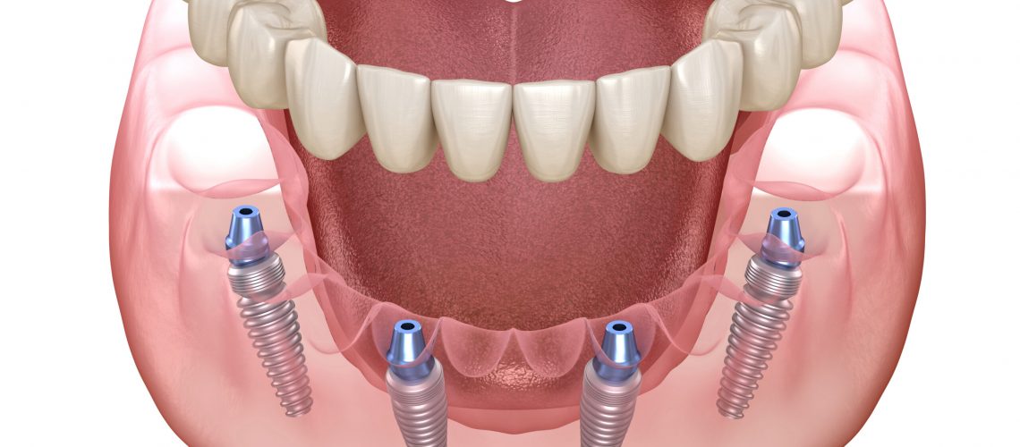 an image of full mouth dental implants.