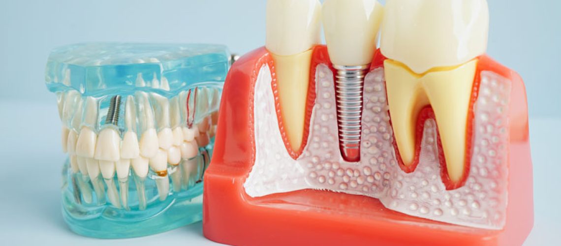 Dental-implant-artificial-tooth-roots-into-jaw-root-canal-of-dental-treatment-gum-disease-teeth-model-for-dentist-studying-about-dentistry