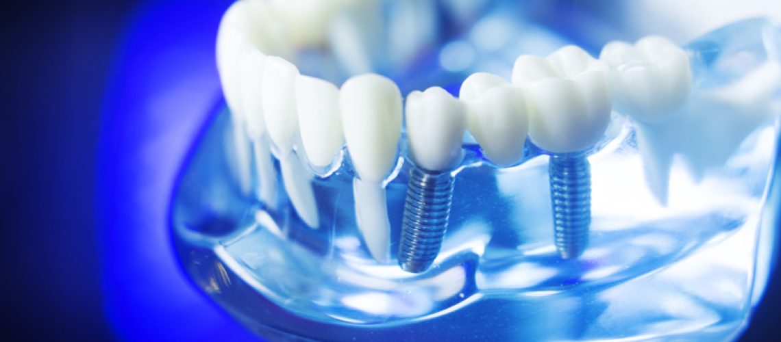 Dental-implant-teeth-dentistry