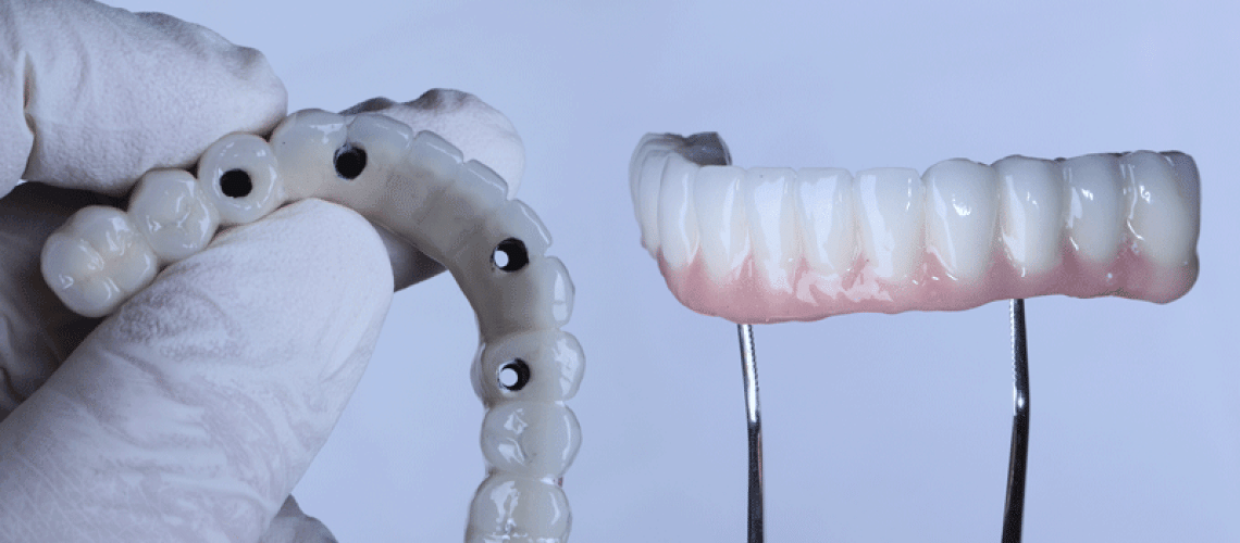 Full arch porcelain dental prosthesis on only 4 implants for completely edentulous jaws in dental jaw surgery and dentistry