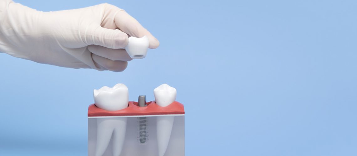 Hand-holds-a-model-of-tooth-implantation