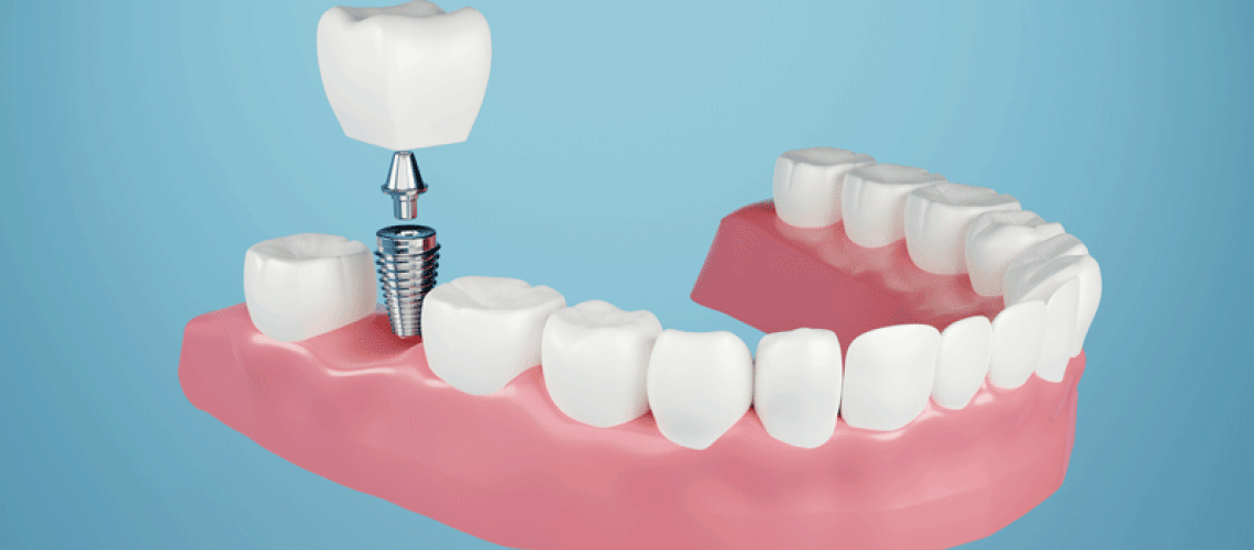 IMP2-Dental-implant-Fix-missing-teeth-with-metal-screw-teeth-crown-treatment-3D-rendering