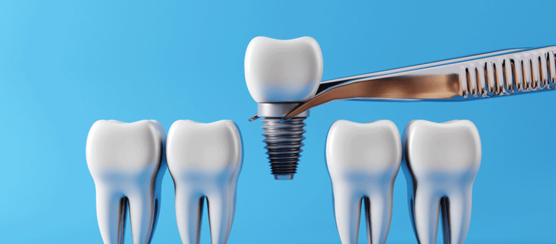 IMP3-Dental-teeth-implants-and-Healthy-white-tooths.-Oral-health-and-dental-inspection-teeth