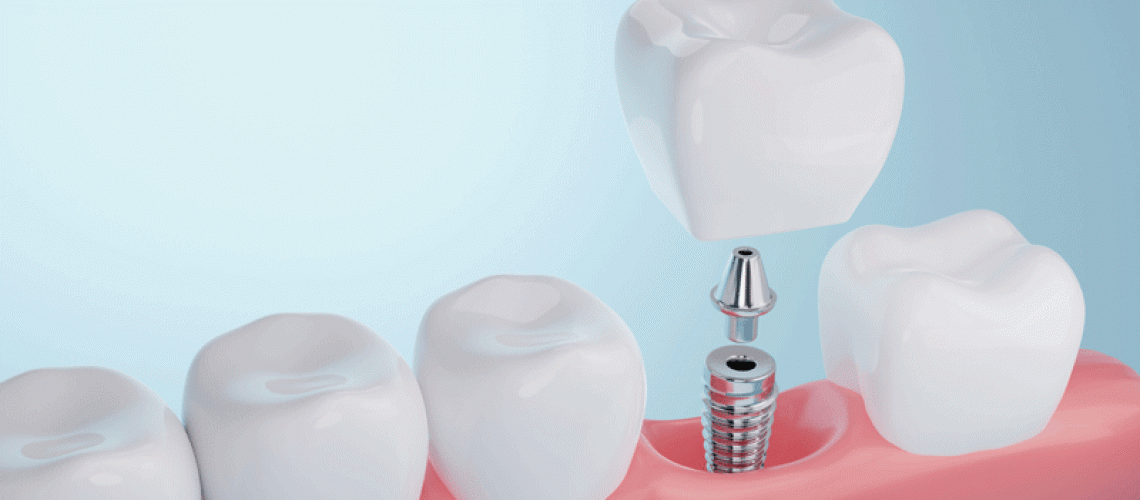 IMP4-Healthy-gums-and-Dental-implant-on-blue-background.-3D-rendering