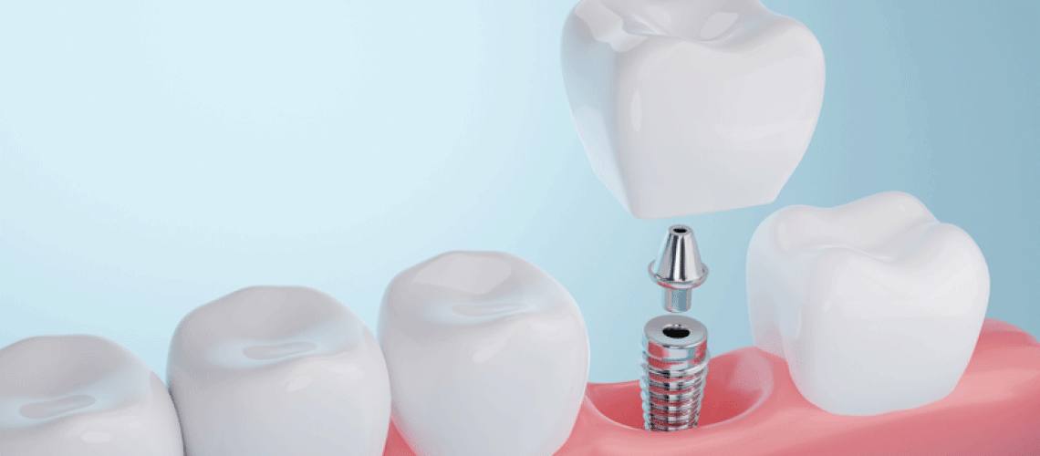 IMP4-Healthy-gums-and-Dental-implant-on-blue-background.-3D-rendering