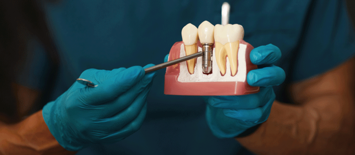 Dentist holding dental implant, artificial tooth roots into jaw, root canal of dental treatment, gum disease, teeth model for dentist.
