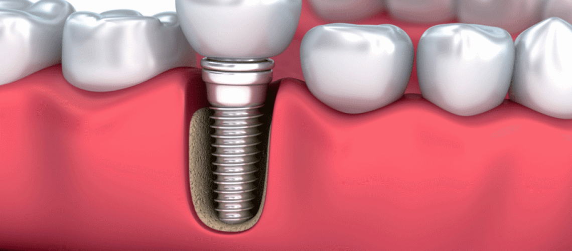 Medically accurate 3D illustration of a Dental Implant