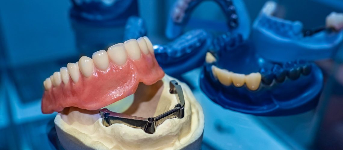 image of a dental implant denture on a prosthesis jaw in a dark and blue aesthetic dental room