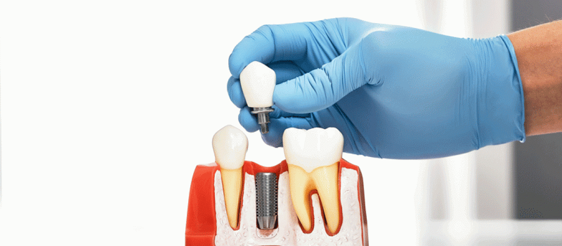 Dentist showing the installation of a dental implant on the anatomical model of teeth