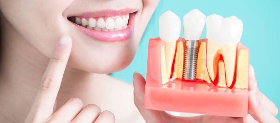 Dental Patient Happily Holding Up A Dental Implant Model, And Pointing to Her Smile