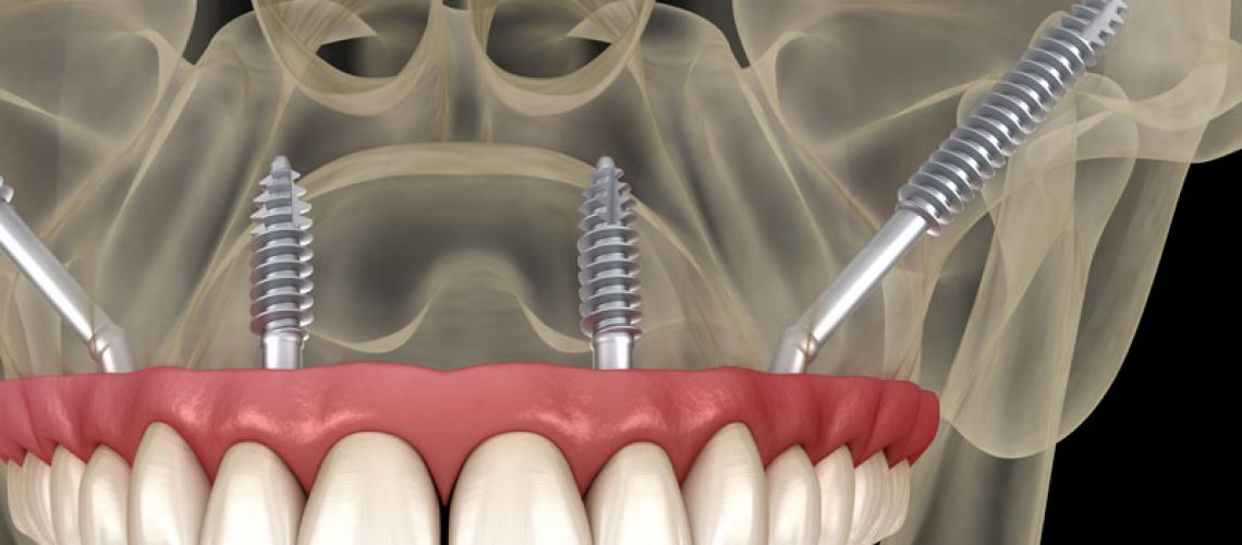 Zygomatic Dental Implants In A Dental Patient's Skull