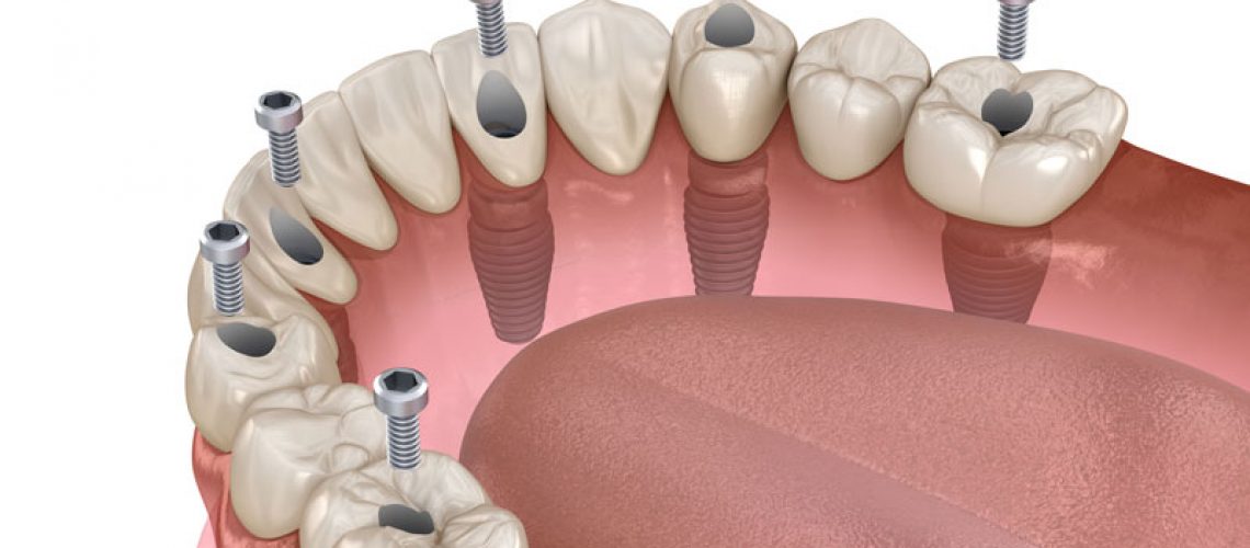a bottom full arch dental implant model that shows how dental implants and a prosthesis can be placed for a full mouth dental implant procedure, after additional procedures are performed.