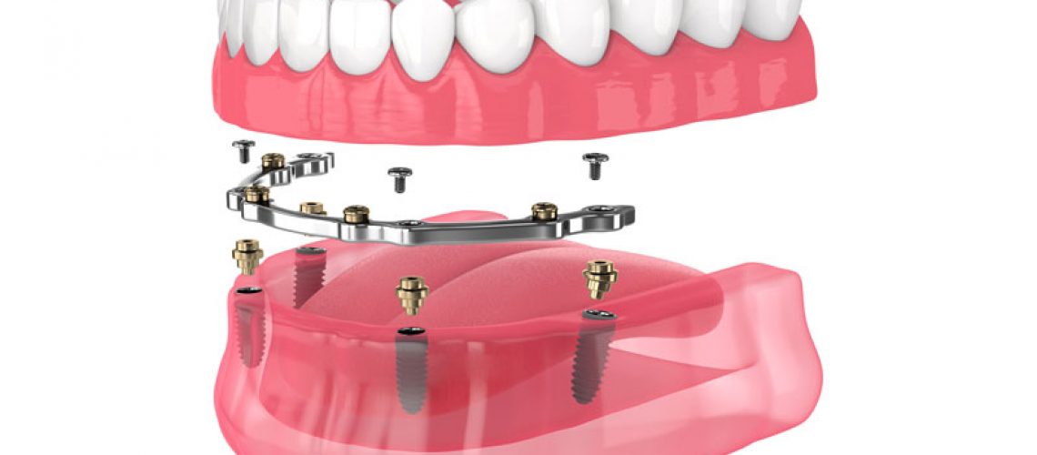 dental implant model - full mouth dental implants.