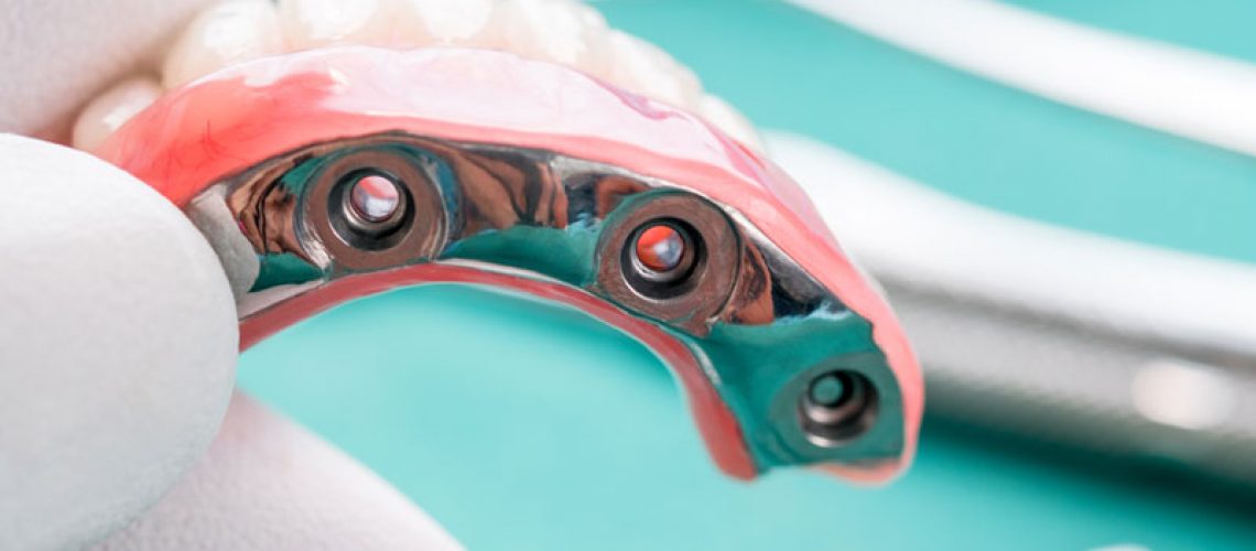 a full mouth dental implant model.