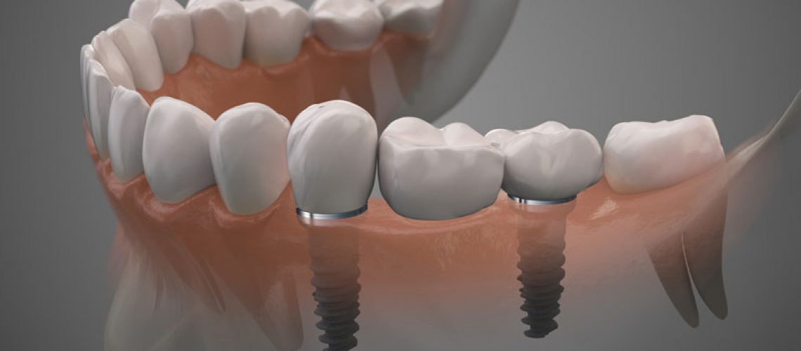 a-single-dental-implant