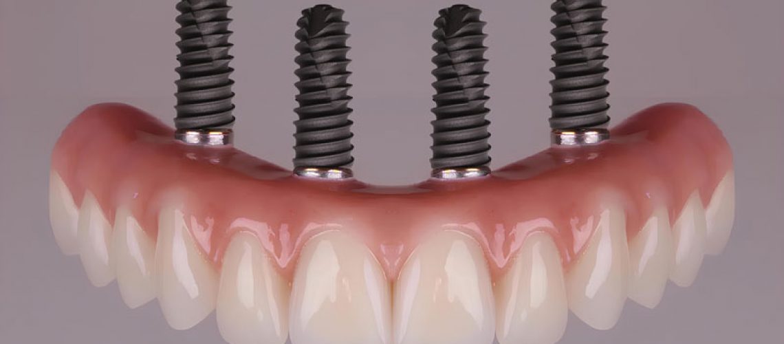 all-4-dental-implants