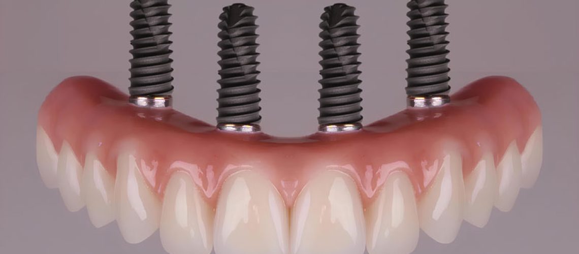 all-4-dental-implants