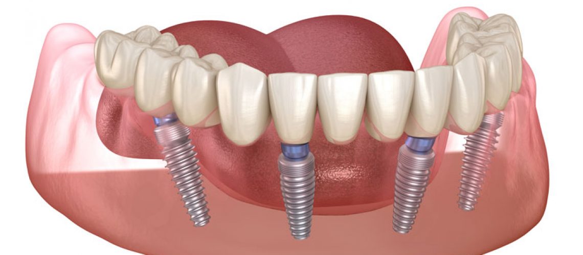 an image of an all-on-4 dental implant model showing four dental implant posts going into the gums with the dentures hovering over the top.