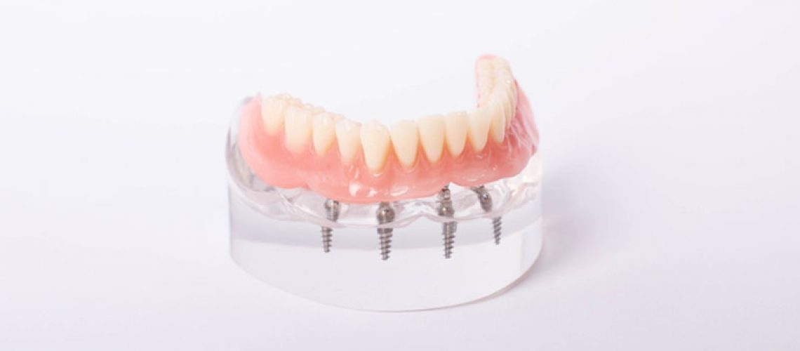 All-on-4 implant-supported denture model on a white background, showing screws and full lower arch fixed to a clear acrylic base.