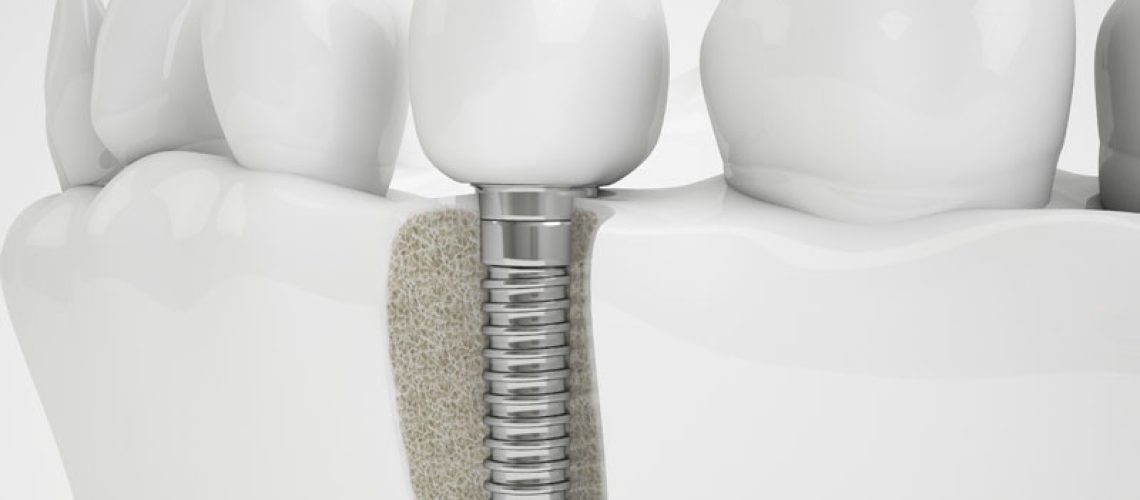 an image of a dental implant placed in a jawbone where a bone grafting treatment was performed.