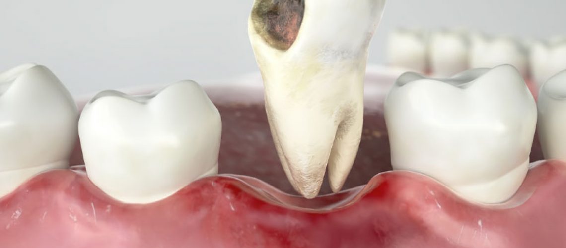 Damaged Tooth Being Pulled Out Of Gums