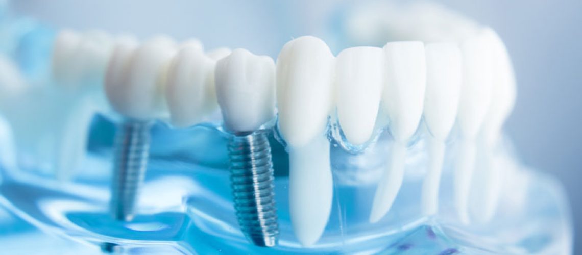 a 3d image of a dental implant image.