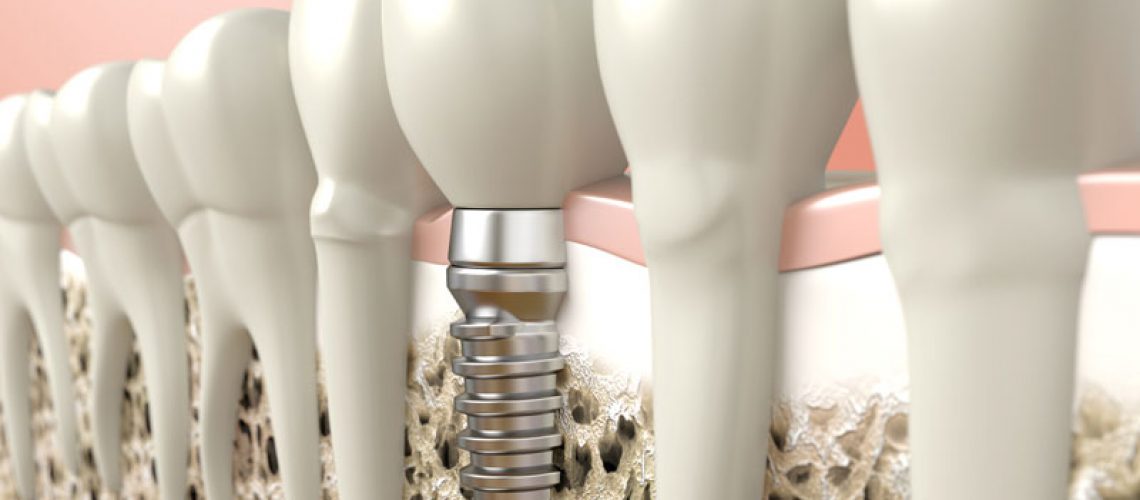 Dental Implants In Your Jaw Bone Surrounded By Natural Teeth